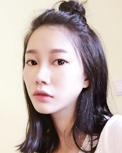 西安陽光整形醫(yī)院邵萍醫(yī)生做鼻綜合整形怎么樣？附鼻綜合整形案例