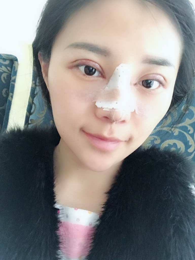 石家莊雅芳亞整形醫(yī)生王文明做雙眼皮+開眼角+鼻綜合整形案例效果對比圖 石家莊雅芳亞整形醫(yī)生王文明做雙眼皮+開眼角+鼻綜合整形案例效果對比圖