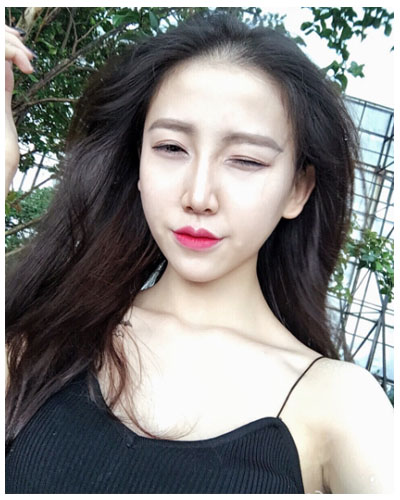 珠海海大整形美容外科黃發(fā)醫(yī)生做面部吸脂怎么樣？附面部吸脂案例