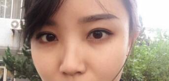 長沙微笑醫(yī)療整形醫(yī)生段雙軍做切開雙眼皮+開內(nèi)眼角效果怎么樣？附案例