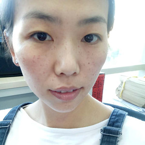 珠海蒂伊醫(yī)療整形醫(yī)生廖俊凱做激光祛斑效果怎么樣？附激光祛斑案例效果圖