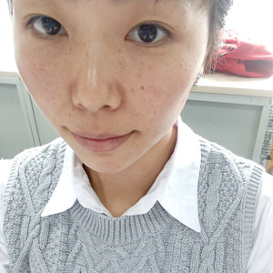 珠海蒂伊醫(yī)療整形醫(yī)生廖俊凱做激光祛斑效果怎么樣？附激光祛斑案例效果圖