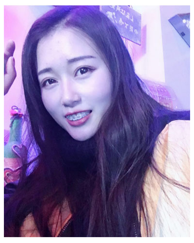 義烏傅氏口腔醫(yī)生朱雨晴做牙齒隱形矯正效果怎么樣？附牙齒隱形矯正案例