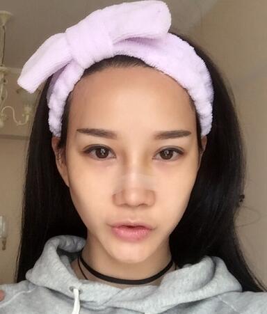 西安陽光整形醫(yī)院邵萍醫(yī)生做鼻綜合整形怎么樣？附鼻綜合整形案例