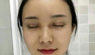 長沙微笑醫(yī)療整形醫(yī)生段雙軍做切開雙眼皮+開內(nèi)眼角效果怎么樣？附案例