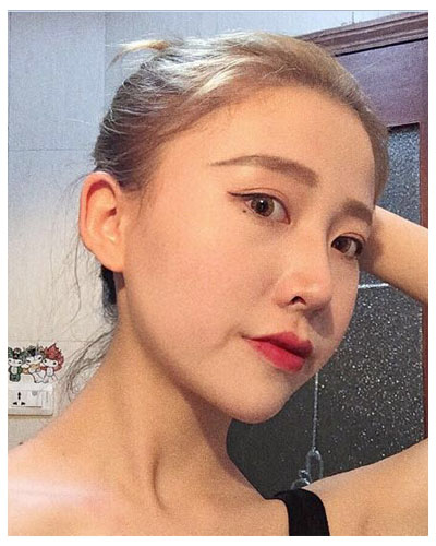 珠海海大整形美容外科黃發(fā)醫(yī)生做面部吸脂怎么樣？附面部吸脂案例