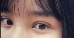 長沙微笑醫(yī)療整形醫(yī)生段雙軍做切開雙眼皮+開內(nèi)眼角效果怎么樣？附案例