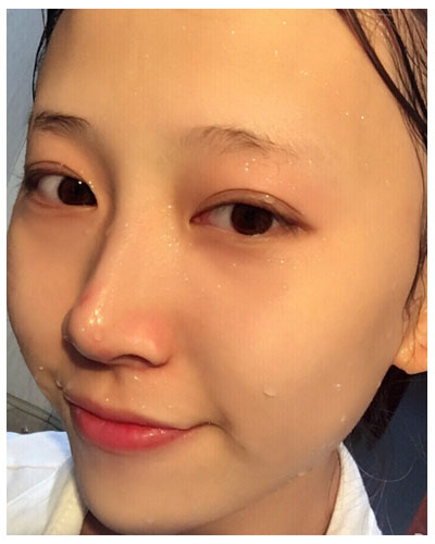 珠海海大整形美容外科黃發(fā)醫(yī)生做面部吸脂怎么樣？附面部吸脂案例