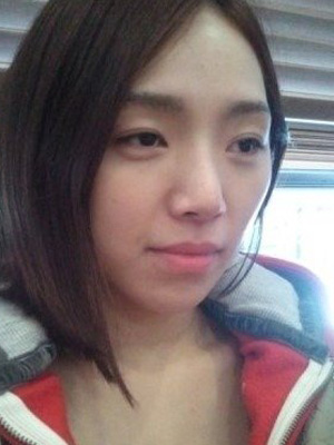 長(zhǎng)春中妍整形醫(yī)院吳學(xué)軍醫(yī)生做玻尿酸墊下巴+玻尿酸豐太陽(yáng)穴案例效果對(duì)比圖