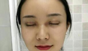 長(zhǎng)沙微笑醫(yī)療整形醫(yī)生段雙軍做切開(kāi)雙眼皮+開(kāi)內(nèi)眼角效果怎么樣？附案例