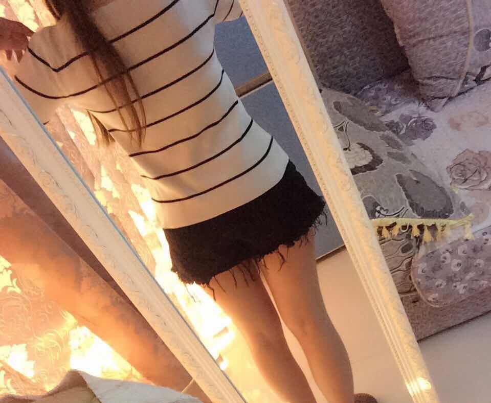 肇慶華美整形醫(yī)院陳巍醫(yī)生做腰腹吸脂效果怎么樣？附腰腹吸脂案例