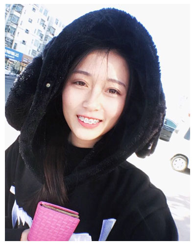 義烏傅氏口腔醫(yī)生朱雨晴做牙齒隱形矯正效果怎么樣？附牙齒隱形矯正案例