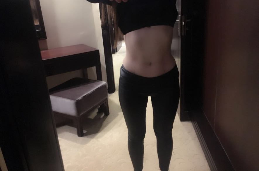 肇慶華美整形醫(yī)院陳巍醫(yī)生做腰腹吸脂效果怎么樣？附腰腹吸脂案例