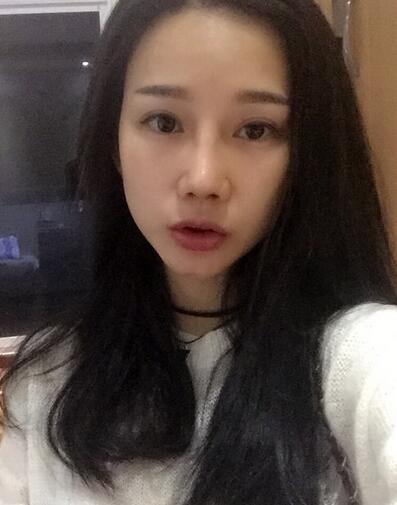 西安陽光整形醫(yī)院邵萍醫(yī)生做鼻綜合整形怎么樣？附鼻綜合整形案例