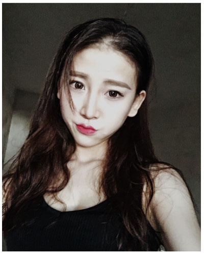 珠海海大整形美容外科黃發(fā)醫(yī)生做面部吸脂怎么樣？附面部吸脂案例