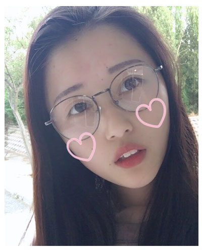 義烏傅氏口腔醫(yī)生朱雨晴做牙齒隱形矯正效果怎么樣？附牙齒隱形矯正案例