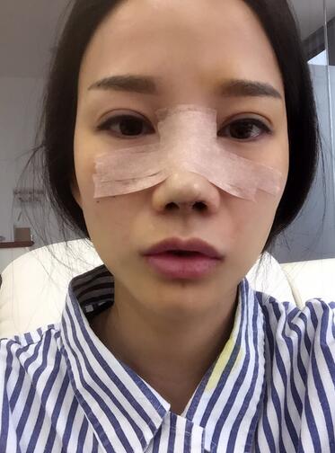 西安陽光整形醫(yī)院邵萍醫(yī)生做鼻綜合整形怎么樣？附鼻綜合整形案例