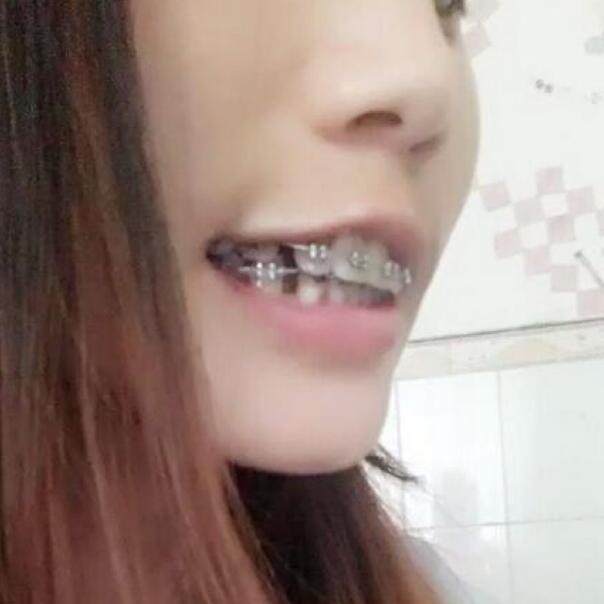 武漢立美整形醫(yī)院張智星醫(yī)生做牙齒矯正效果怎么樣？附牙齒矯正案例