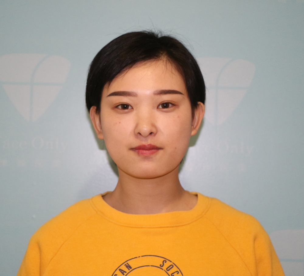 武漢肽慕醫(yī)美整形醫(yī)院楊婉菱醫(yī)生做面部吸脂效果怎么樣？附面部吸脂案例