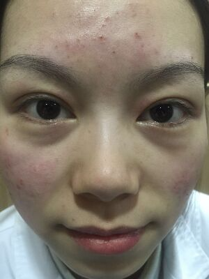 西安壹加壹整形醫(yī)院劉晨醫(yī)生做點(diǎn)陣激光祛痘效果怎么樣？附點(diǎn)陣激光祛痘效果圖