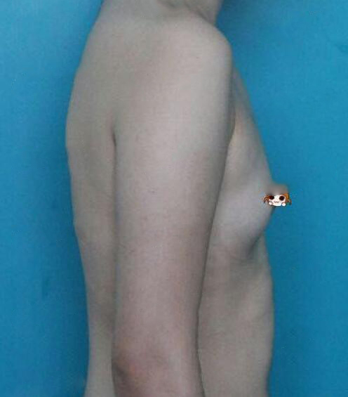 武漢華美整形醫(yī)院趙曉兵醫(yī)生做自體脂肪隆胸怎么樣？附自體脂肪隆胸案例