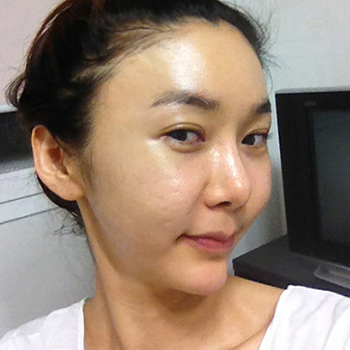 周口華美整形醫(yī)院翟紅光醫(yī)生做面部除皺效果怎么樣？附案例效果對(duì)比圖