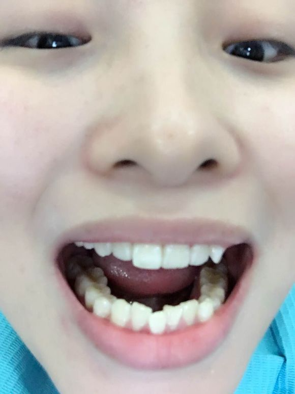 重慶齊美口腔周映丞醫(yī)生做牙齒隱形矯正怎么樣？附牙齒隱形矯正案例