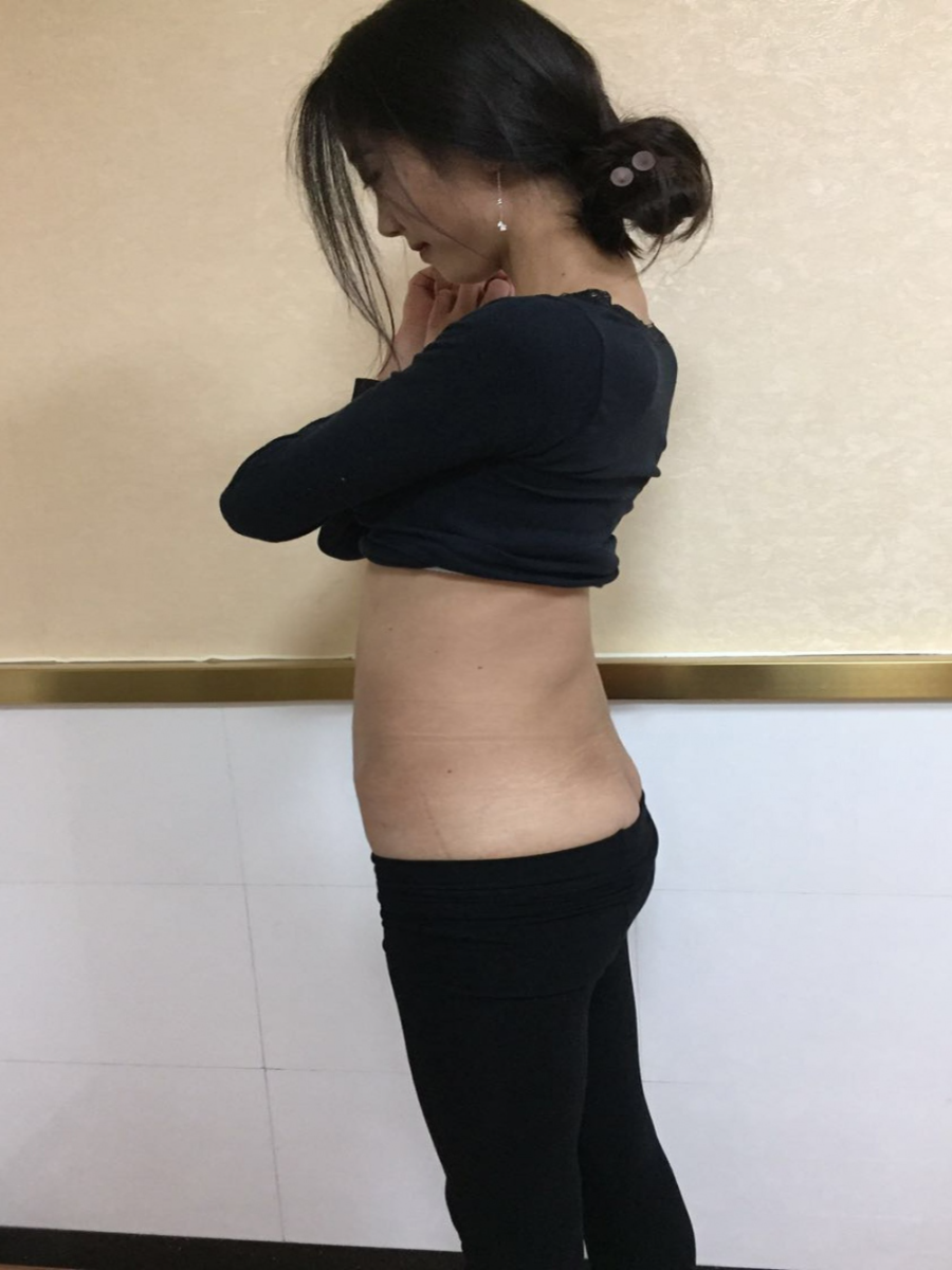 北京東方瑞麗整形醫(yī)生夏兆驥做腰腹吸脂效果怎么樣？附腰腹吸脂案例效果對(duì)比圖