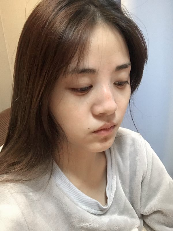 駐馬店締萊美醫(yī)療整形醫(yī)生李冰做鼻綜合整形怎么樣？附鼻綜合整形案例效果對比圖