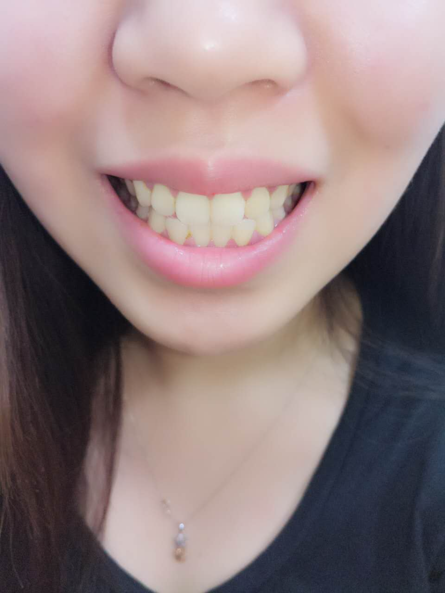 杭州國雅口腔醫(yī)院張虹醫(yī)生做冷光美白效果怎么樣？附冷光美白案例效果對比圖