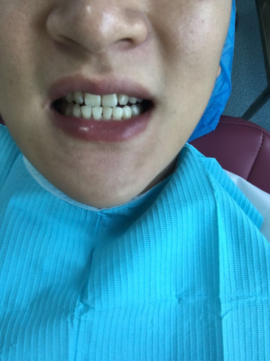 淮北博愛(ài)口腔醫(yī)院做牙齒瓷貼面怎么樣？附李龍醫(yī)生案例效果對(duì)比圖