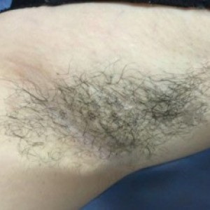 廈門張銘整醫(yī)療整形醫(yī)生張小玲做激光脫腋毛怎么樣？附激光脫腋毛效果對比圖
