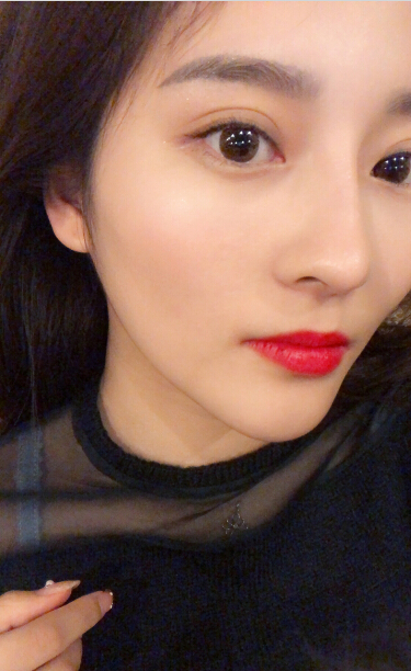 張家港唯恩整形醫(yī)院陳天杰醫(yī)生切開雙眼皮案例效果對比圖