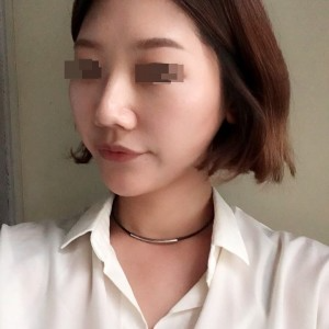 太原麗都整形醫(yī)院劉晉艷醫(yī)生做光纖溶脂瘦臉怎么樣？附案例效果對(duì)比圖