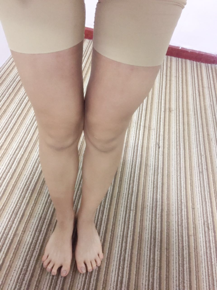 北京蒂凡妮整形靳玉彪醫(yī)生做大腿吸脂怎么樣？附大腿吸脂案例效果對比圖