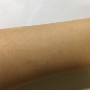 鄭州屈小麗醫(yī)療整形醫(yī)院醫(yī)生劉丹做手臂脫毛怎么樣？附手臂脫毛案例