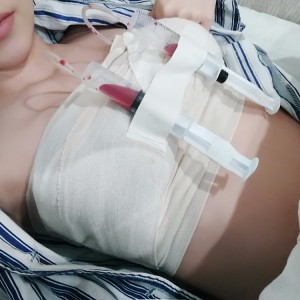 廣州廣大整形美容醫(yī)院醫(yī)生查旭山做假體隆胸怎么樣？附案例