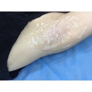 廈門張銘整醫(yī)療整形醫(yī)生張小玲做激光脫腋毛怎么樣？附激光脫腋毛效果對(duì)比圖