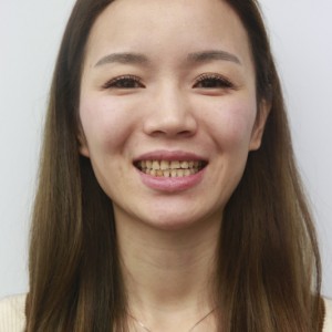 安慶渡江口腔醫(yī)院張良斌醫(yī)生牙齒貼面怎么樣？附牙齒貼面效果圖