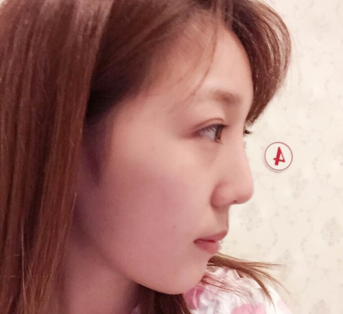 鄭州致美士整形醫(yī)院醫(yī)生閆江濤做鼻綜合+自體脂肪填充+吸脂案例效果對(duì)比圖