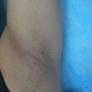 廈門張銘整醫(yī)療整形醫(yī)生張小玲做激光脫腋毛怎么樣？附激光脫腋毛效果對(duì)比圖