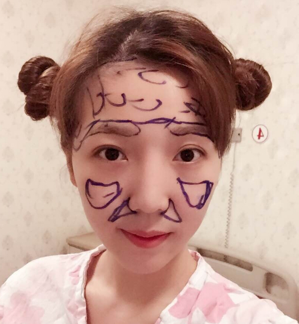 鄭州致美士整形醫(yī)院醫(yī)生閆江濤做鼻綜合+自體脂肪填充+吸脂案例效果對比圖