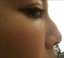 天津時(shí)光整形醫(yī)生盧丙侖做駝峰鼻怎么樣？附案例效果對比圖