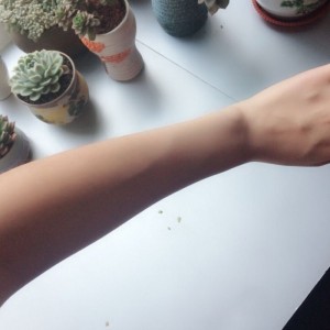 鄭州屈小麗醫(yī)療整形醫(yī)院醫(yī)生劉丹做手臂脫毛怎么樣？附手臂脫毛案例