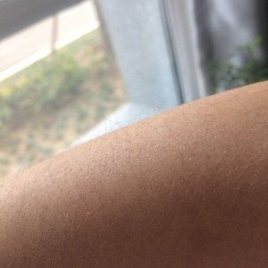 鄭州屈小麗醫(yī)療整形醫(yī)院醫(yī)生劉丹做手臂脫毛怎么樣？附手臂脫毛案例