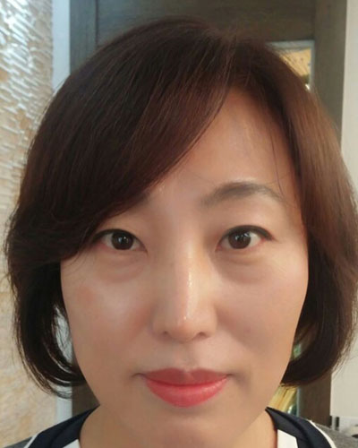 北京四季美學(xué)炫美整形醫(yī)生高玲做埋線祛眼袋怎么樣？附案例效果對比圖