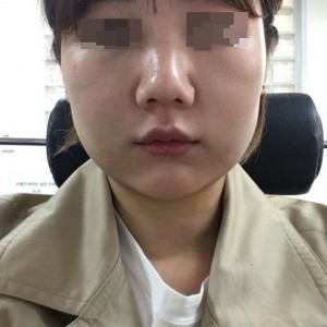 太原麗都整形醫(yī)院劉晉艷醫(yī)生做光纖溶脂瘦臉怎么樣？附案例效果對(duì)比圖