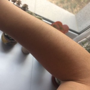 鄭州屈小麗醫(yī)療整形醫(yī)院醫(yī)生劉丹做手臂脫毛怎么樣？附手臂脫毛案例