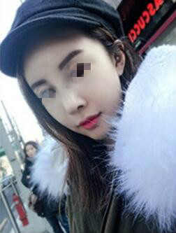 天津時(shí)光整形醫(yī)生盧丙侖做駝峰鼻怎么樣？附案例效果對比圖