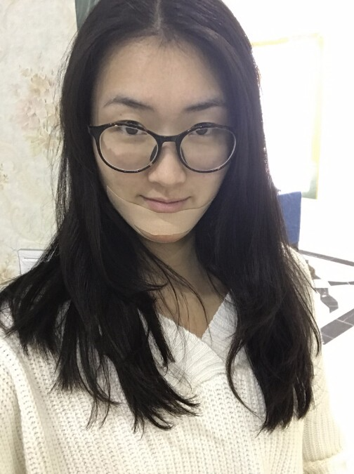 武漢中翰整形外科醫(yī)院做硅膠墊下巴怎么樣？附朱紅霞醫(yī)生案例效果對(duì)比圖